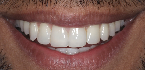 Huz After Invisalign treatment in Wimbledon