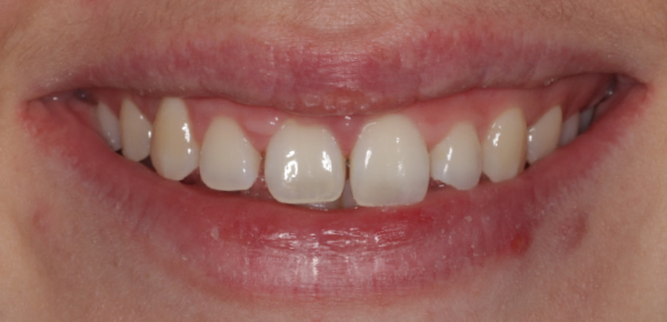 Laura Before Invisalign treatment in Wimbledon